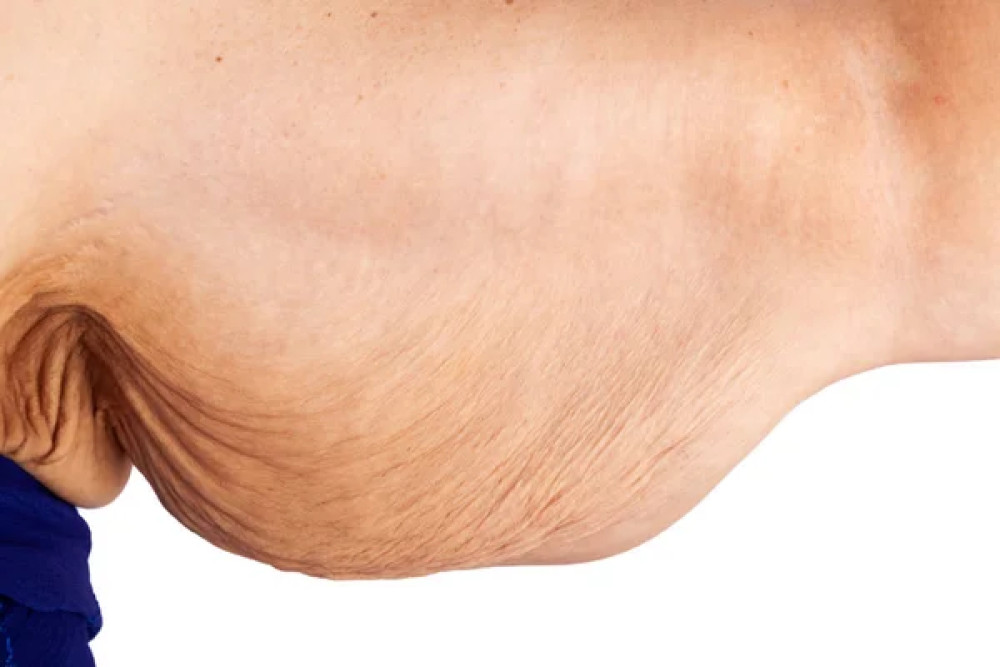 Povislá kůže po zhubnutí – tvarování těla po Ozempic a Mounjaro