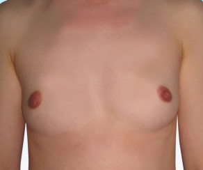 Breast augmentation 