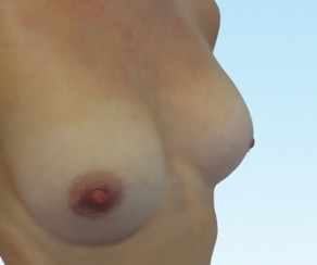 Foto před zákrokem: Výměna prsních implantátů (foto 10)