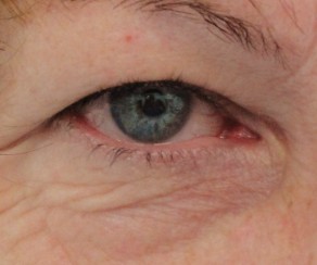 Eyelid surgery