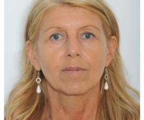 Foto před zákrokem: Facelifting obličeje - projekt Proměna, Health and Beauty  (foto 17)