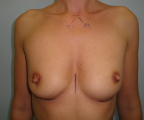 Augmentation - Brustvergrößerung