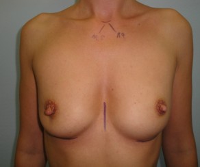 Breast augmentation 