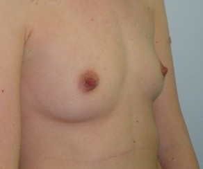 Foto před zákrokem: Augmentace - zvětšení prsou (foto 2)