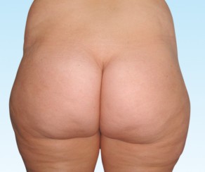 Liposuction