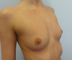 Foto před zákrokem: Zvětšení prsou anatomickými implantáty Mentor  (foto 25)