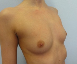 Breast Augmentation Mentor CPG 295