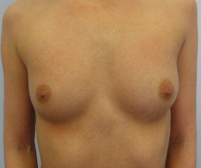 Foto před zákrokem: Zvětšení prsou implantáty (foto 26)