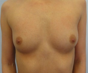 Breast Augmentation