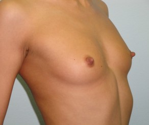 Před: Augmentace - zvětšení prsou (foto 3) Foto před zákrokem: Augmentace - zvětšení prsou (foto 3)