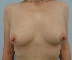 Foto před zákrokem: Zvětšení prsou vlastním tukem (foto 34)