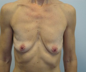 Foto před zákrokem: Augmentace a modelace prsou (foto 35)
