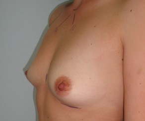 Breast augmentation 