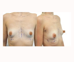 Foto před zákrokem: Redukce prsou s modelací | MUDr. Ivo Menšík, Ph.D. (foto 53)
