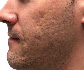 Foto vor dem Eingriff: Diodenlaser mit 3D IPL (foto 55)