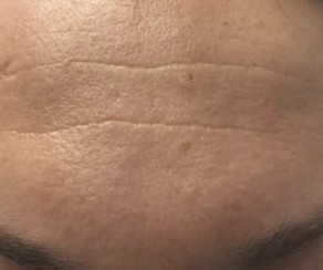 Foto před Frakční ablativní CO2 laser