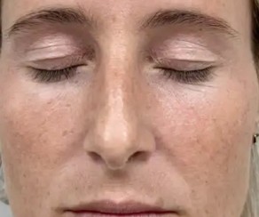 Foto před diodový laser s 3D IPL