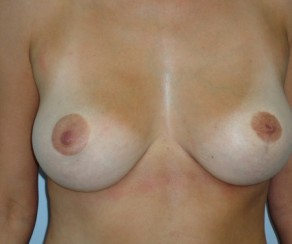 Breast reduction