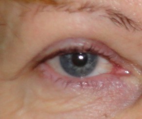 Abänderung von Augenlidern