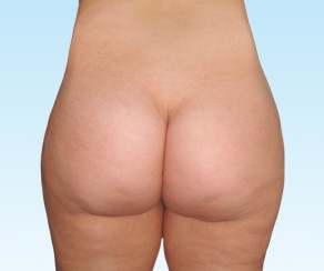 Liposuction