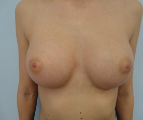 Augmentation - Brustvergrößerung