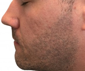 Foto nach dem Eingriff: Diodenlaser mit 3D IPL (foto 55)