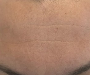 Foto po Frakční ablativní CO2 laser