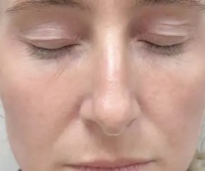 Foto po diodový laser s 3D IPL