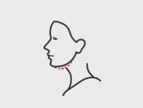 Injektions-Lipolyse
