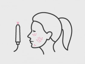 Laser-Behandlung