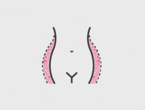 Liposuktion